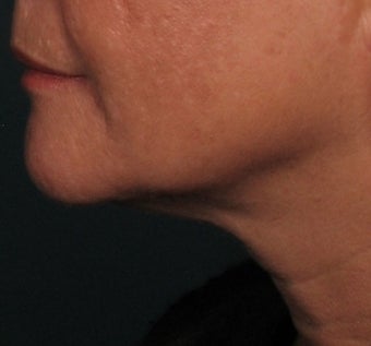 Ulthera Laser Skin Tightening after 346279