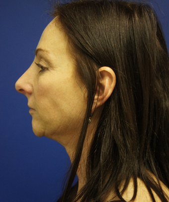 Ultherapy after 625403