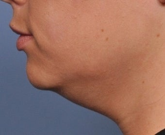 Skin Tightening before 332574