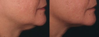 Ulthera Laser Skin Tightening before 346269