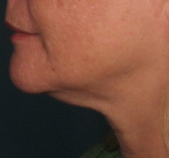 Ulthera Laser Skin Tightening before 346279