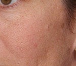 V Beam treatment for Rosacea after 125412