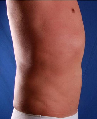 VASER Shape to Abdomen after 433042
