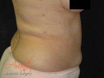 Vaser Lipo - Abdomen after 376425
