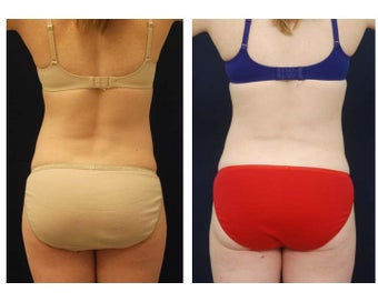 Liposuction after 397085
