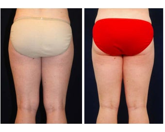Liposuction after 397096