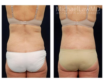 Liposuction after 397121