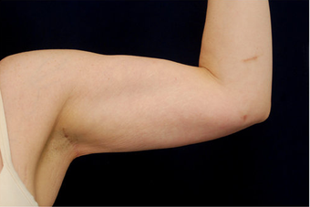 Liposuction after 397146