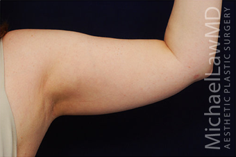 Liposuction after 400283