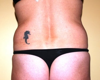 Ultrasonic assisted (Vaser) Liposuction of Flanks before 235766