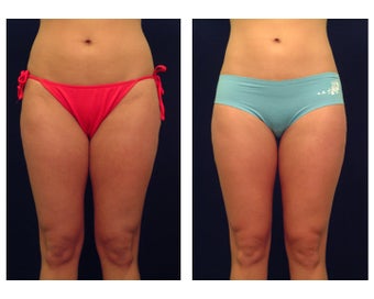 Liposuction before 286662
