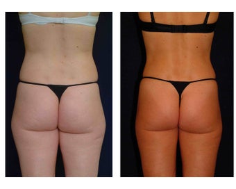 Liposuction before 286696