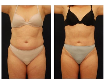 Liposuction before 286726