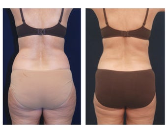 Liposuction before 286768