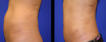 Vaser Liposuction before 294696