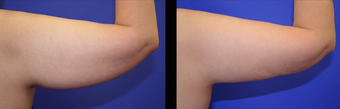 Vaser Liposuction before 294700