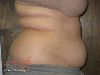 Vaser Lipo - Abdomen before 376425