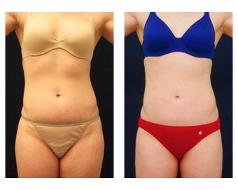 Liposuction before 397085
