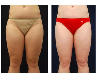 Liposuction before 397096