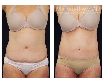 Liposuction before 397121