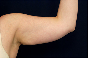 Liposuction before 397146