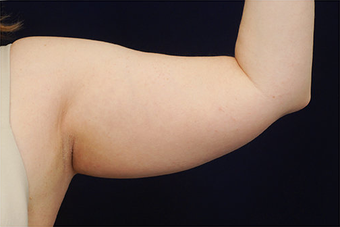 Liposuction before 400283