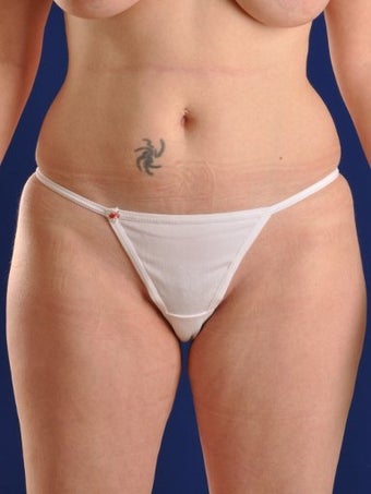 Vaser Hi Def Liposuction of abdomen, thighs, flanks and back with fat injections to buttocks before 422671