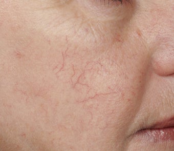 Yag laser before 140106