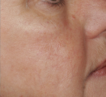 Yag laser after 140106