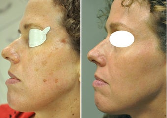 Nd:YAG laser for sunspots before 388077