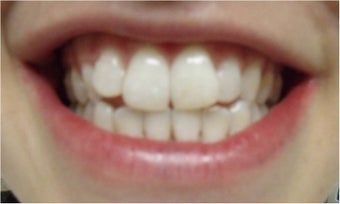 Zoom! Laser Whitening after 326054