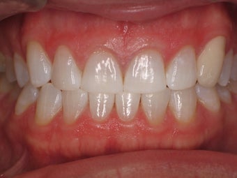 Tooth Whitening after 366619