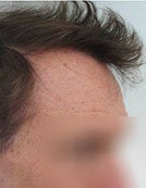 Head and Beard Hair FUE-BHT-SFET to fix follicular unit strip surgery after 195652