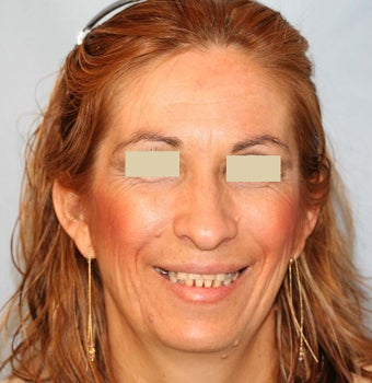 Dentures before 109201