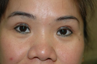 Asian eyelid surgery -- Double lid crease procedure 341490
