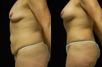 Tummy Tuck and Breast Augmentation, gel implants 392054