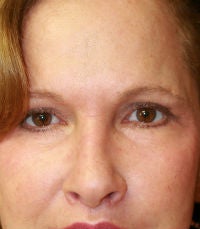 blepharoplasty after 309062
