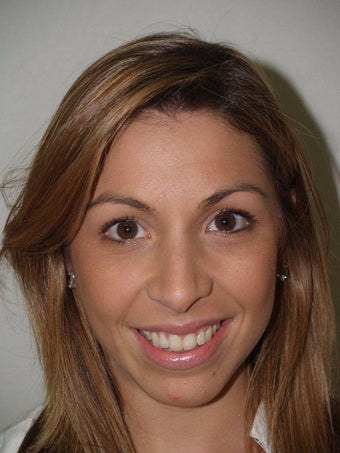 Rhinoplasty before 214513