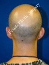 Ear Surgery (Otoplasty) 579096