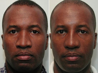 Ethnic Rhinoplasty - African American Male before 44103
