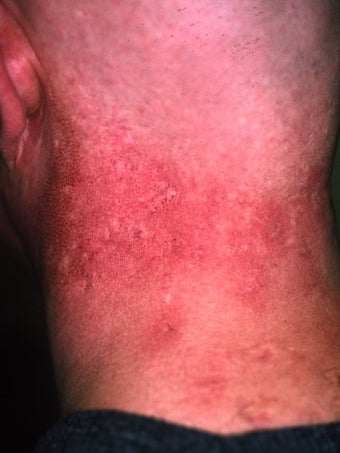 Acne Scarring after 417355