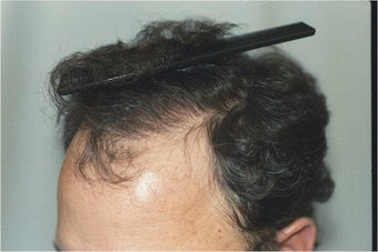 Hair Transplantation after 109450