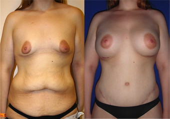 Lower Body lift, Breast Augmentation before 543105