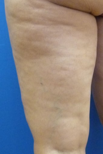 Cellulaze after 582382
