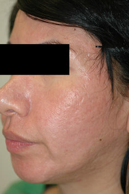 Erbium Laser Resurfacing for Acne Scars after 82973