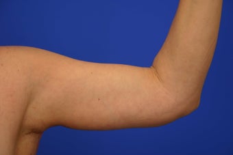 Arm lift after 461867