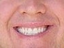 Porcelain Veneers after 109168