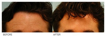 Botox before 138523