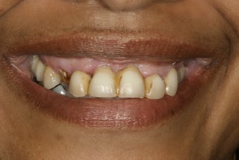Full Mouth Restoration before 389308