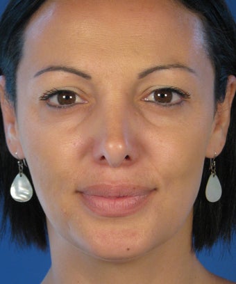 Revision Rhinoplasty before 410783